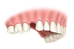 Zahnimplantat für Einzelzahnlücke